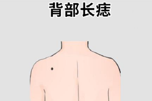 后背上的痣图解大全男 后背上的痣图解大全男人