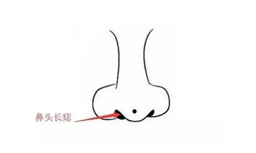 男人鼻子上有痣图解 男人鼻子上有痣图解大全