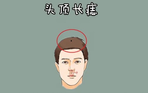 头顶长痣命运图解 头顶长痣命运如何