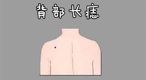 后背长痣代表什么含义男 男人背上有痣代表什么