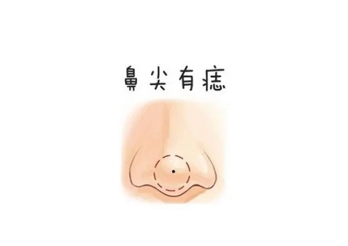 鼻尖上痣的位置与命运 鼻尖上有痣的女人一定有财吗