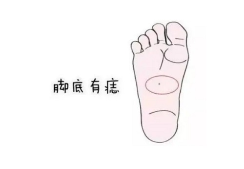 右脚脚底有痣代表什么 右脚脚底有痣的女人命运